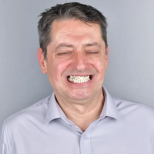 Pacient înainte de tratamentul implantar, NeoSmile