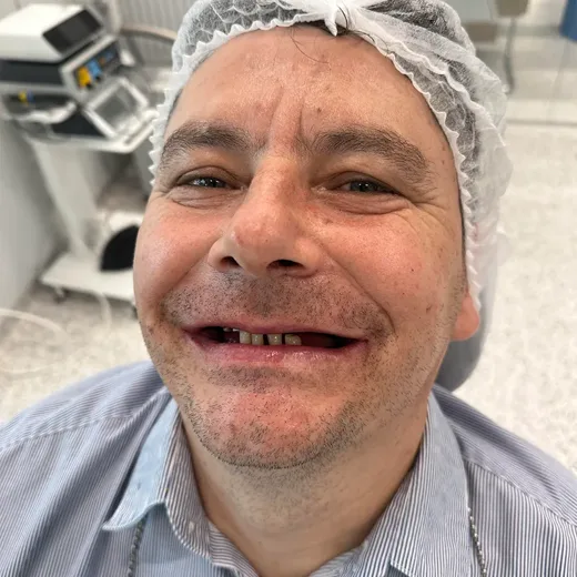 Pacient înainte de tratamentul implantar, NeoSmile