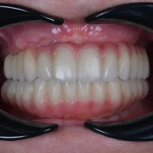 Arcadă dentară după dinți ficși pe implanturi, NeoSmile