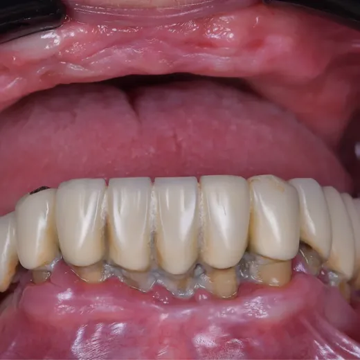 Arcadă dentară înainte de tratamentul implantar, NeoSmile