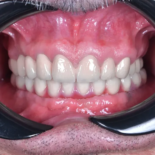 Arcadă dentară după dinți ficși pe implanturi, NeoSmile