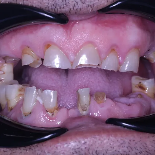 Arcadă dentară înainte de tratamentul implantar, NeoSmile
