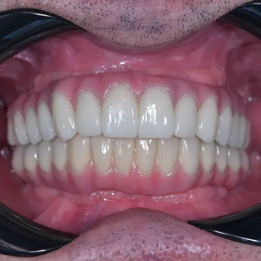 Arcadă dentară după dinți ficși în 24h pe implanturi, NeoSmile Iași și Roman