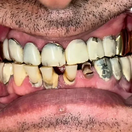 Arcadă dentară înainte de dinți ficși, dinți deteriorați, NeoSmile Iași